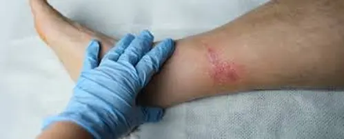 Preventing a Scar